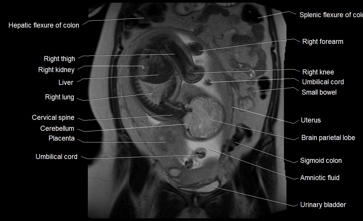 MRI Anatomy of pregnancy image 16.webp